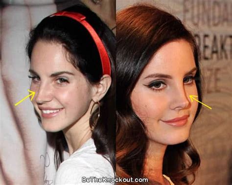 lana del rey nose surgery